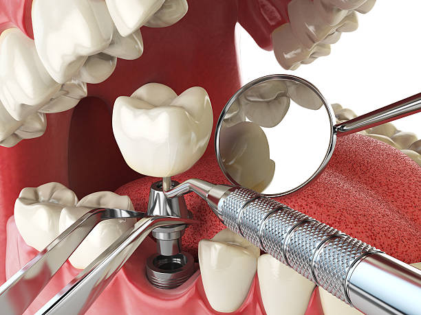 Best Tooth Infection Emergency Dentist  in Untain View, MO